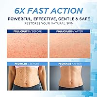 Hermon Folliculitis Treatment Cream 100g — image 2