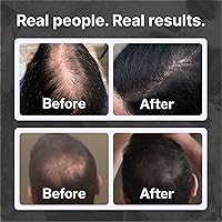 Shapiro MD Hair Loss Shampoo, 2 Month Supply — image 4