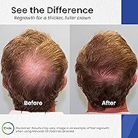 C’rcle Men’s Minoxidil 5% Foam 6-Month Supply — image 3